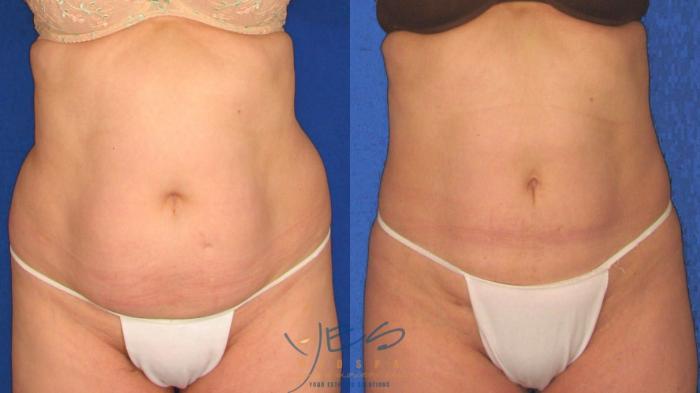 Before & After Liposuction Case 18 View #1 View in Vancouver, BC