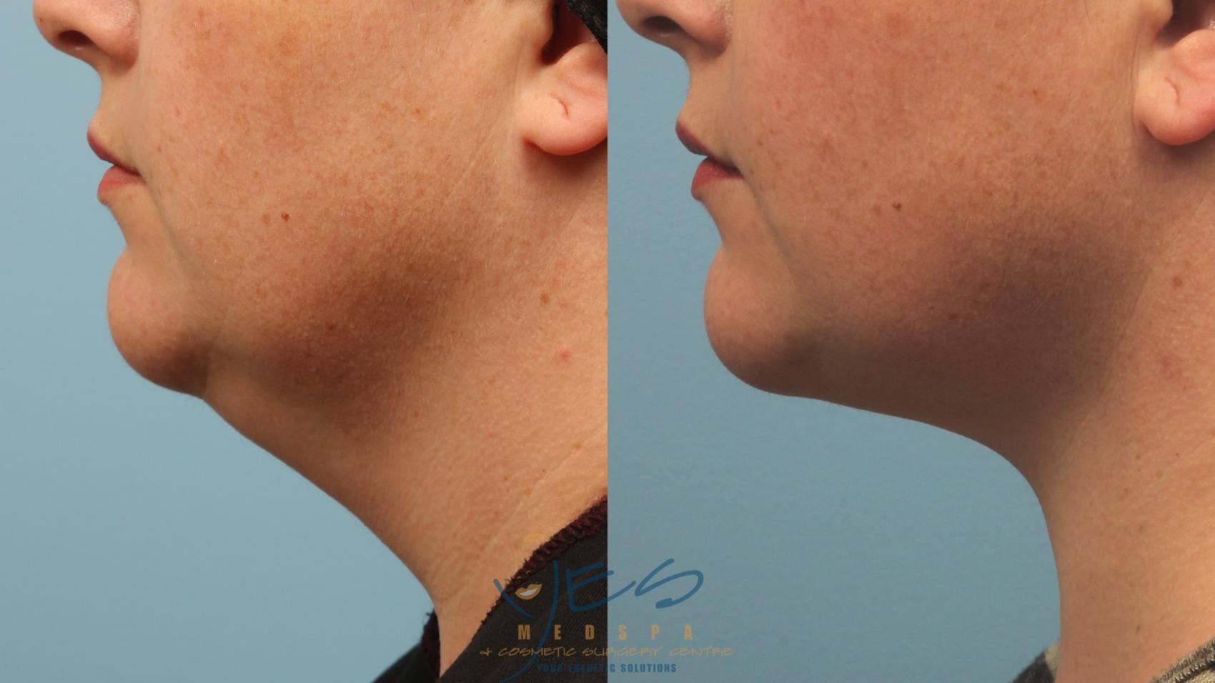 Before & After Liposuction Case 230 Left Side View in Vancouver, BC