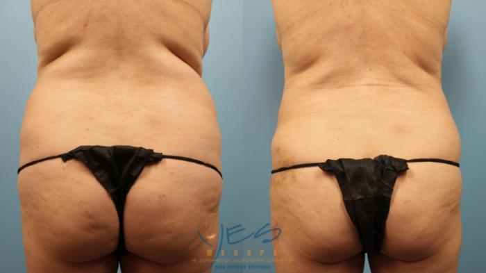 Before & After Liposuction Case 245 Back View in Vancouver, BC