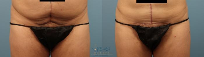 Before & After Liposuction Case 245 Front View in Vancouver, BC