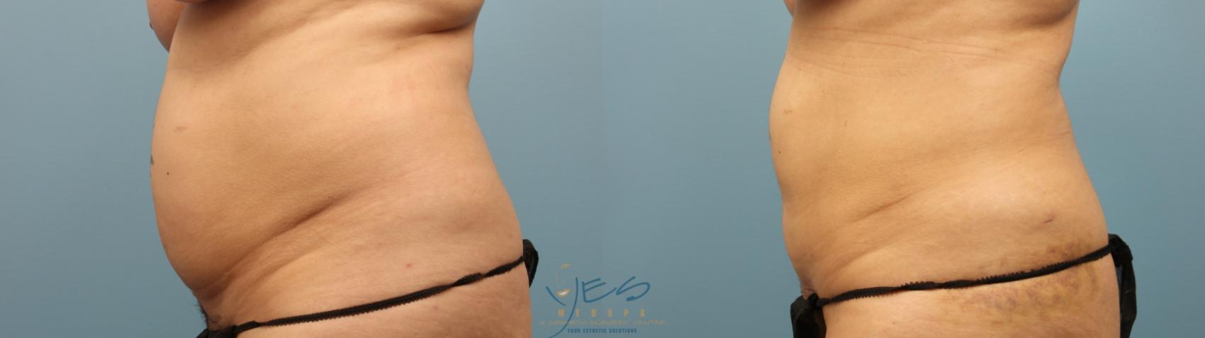 Before & After Liposuction Case 245 Left Side View in Vancouver, BC