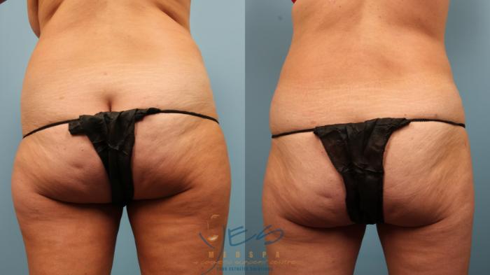 Before & After Breast Lift Case 308 Back View in Vancouver, BC