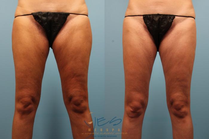 Before & After Liposuction Case 308 Front View in Vancouver, BC