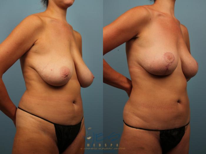 Before & After Breast Lift Case 308 Right Oblique View in Vancouver, BC