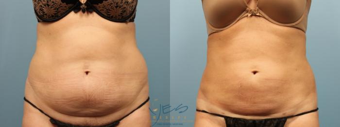 Before & After Liposuction Case 310 Front View in Vancouver, BC