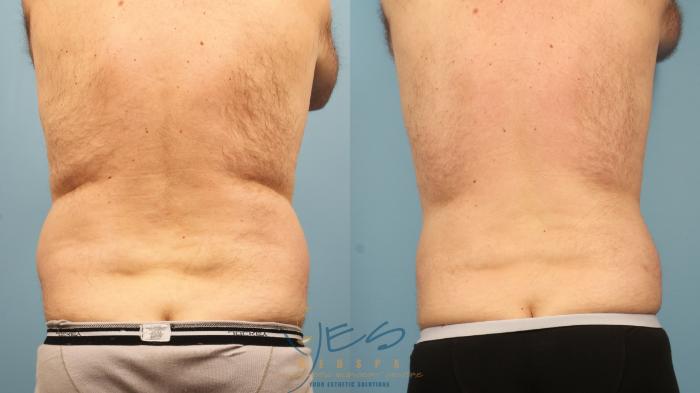 Before & After Liposuction Case 367 Back View in Vancouver, BC