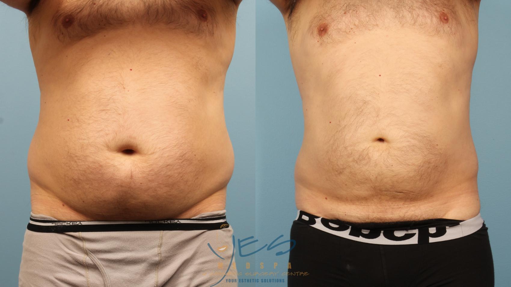 Before & After Liposuction Case 367 Front View in Vancouver, BC