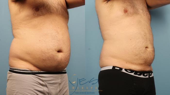 Before & After SmartLipo™ Case 367 Right Oblique View in Vancouver, BC