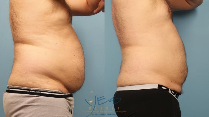 Before & After Liposuction Case 367 Right Side View in Vancouver, BC