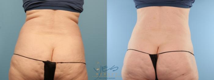 Before & After Liposuction Case 382 Back View in Vancouver, BC