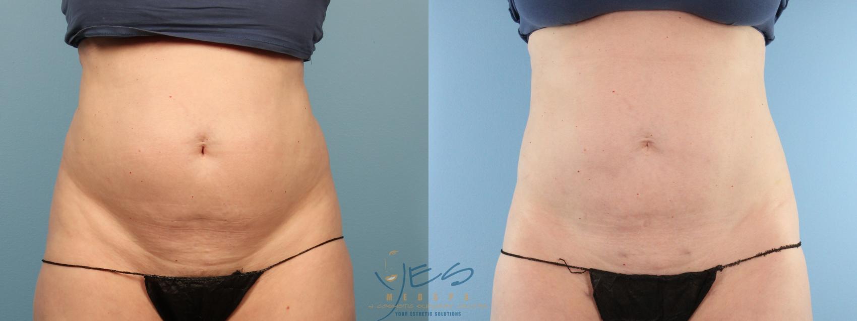 Before & After Liposuction Case 382 Front View in Vancouver, BC