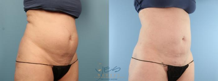 Before & After Liposuction Case 382 Right Oblique View in Vancouver, BC
