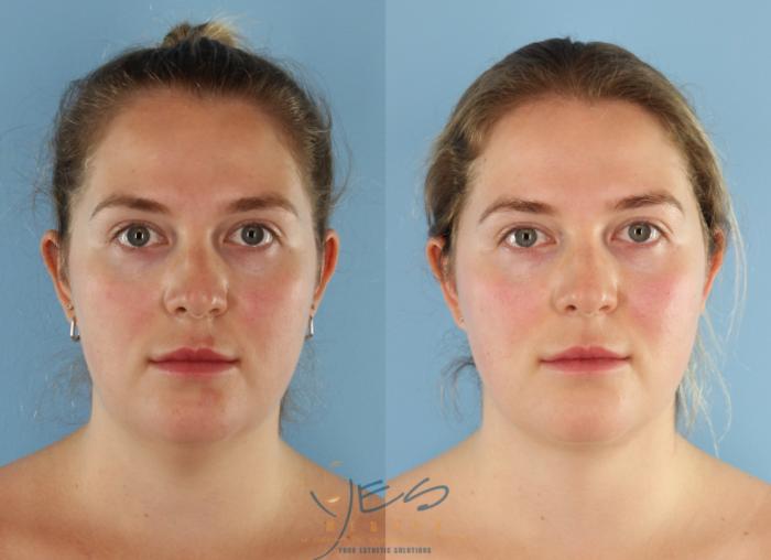 Before & After Liposuction Case 431 Front View in Vancouver, BC