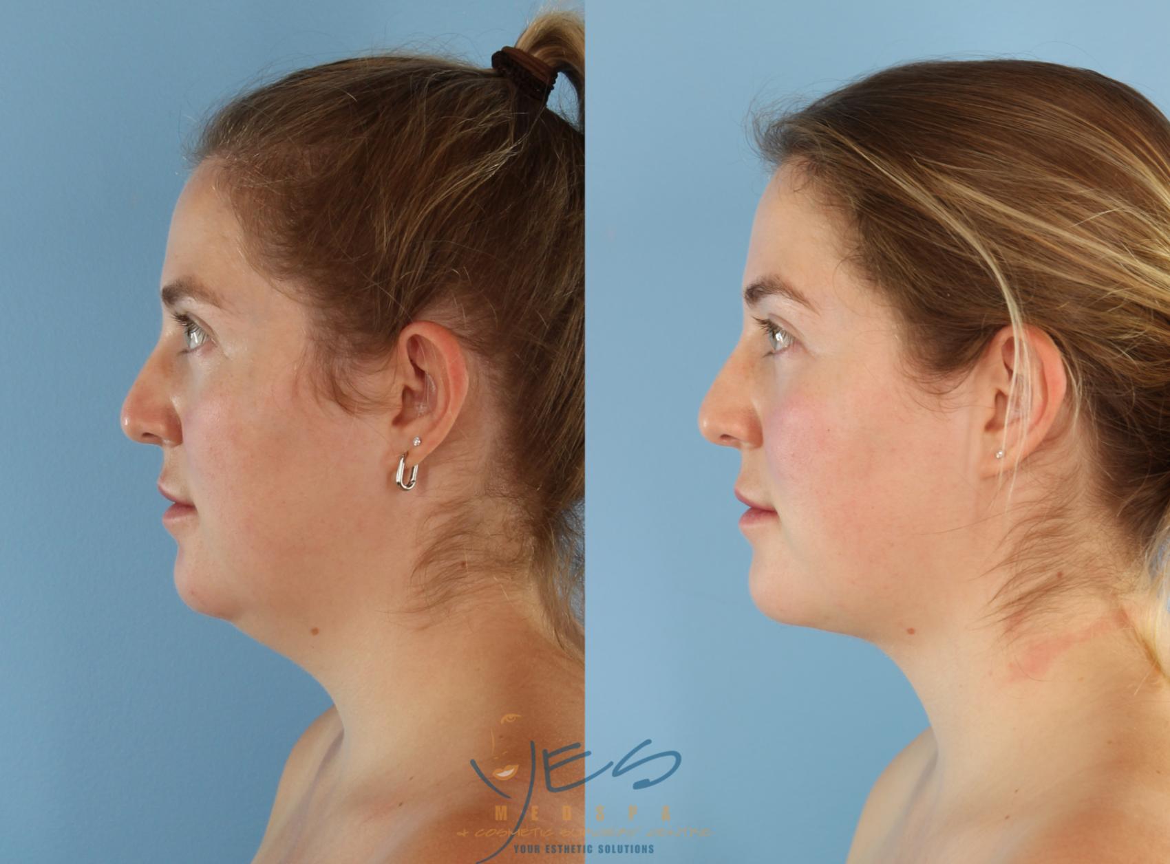 Before & After Liposuction Case 431 Left Side View in Vancouver, BC