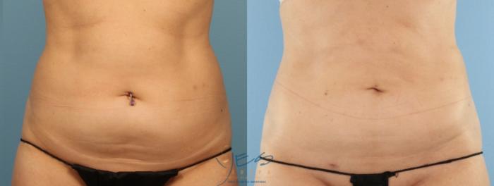 Before & After Liposuction Case 440 Front View in Vancouver, BC