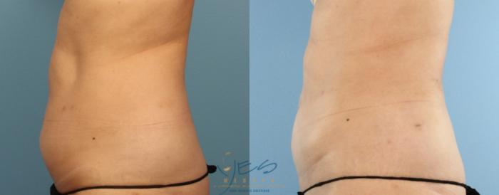 Before & After Liposuction Case 440 Left Side View in Vancouver, BC