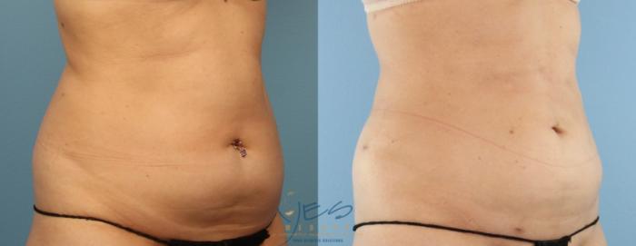 Before & After Liposuction Case 440 Right Oblique View in Vancouver, BC