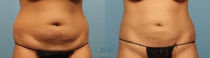 Before & After Liposuction Case 458 Front View in Vancouver, BC