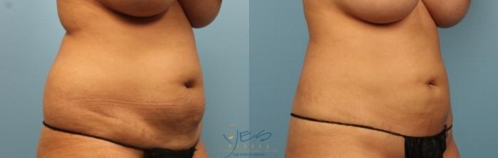 Before & After Liposuction Case 458 Right Oblique View in Vancouver, BC