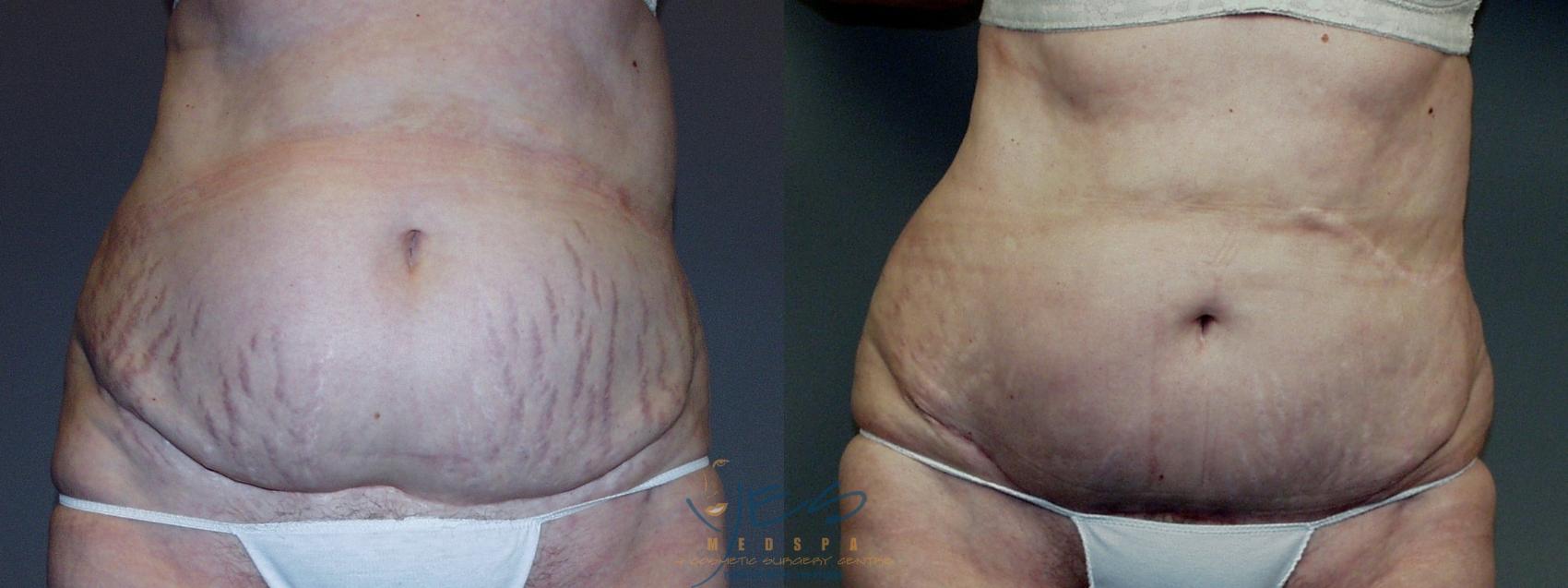 Before & After Tummy Tuck Case 48 Front View in Vancouver, BC