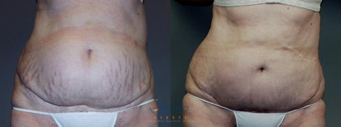 Before & After Tummy Tuck Case 48 Front View in Vancouver, BC