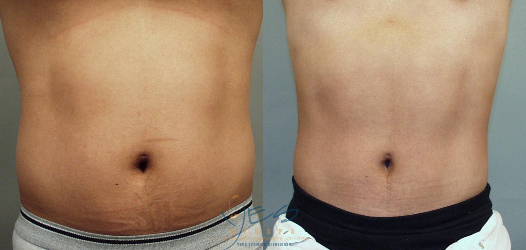 Patient 8284, Flank-Lower Back Liposuction, Male Liposuction Gallery