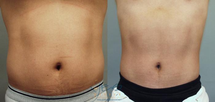 Before & After Liposuction Case 49 Front View in Vancouver, BC