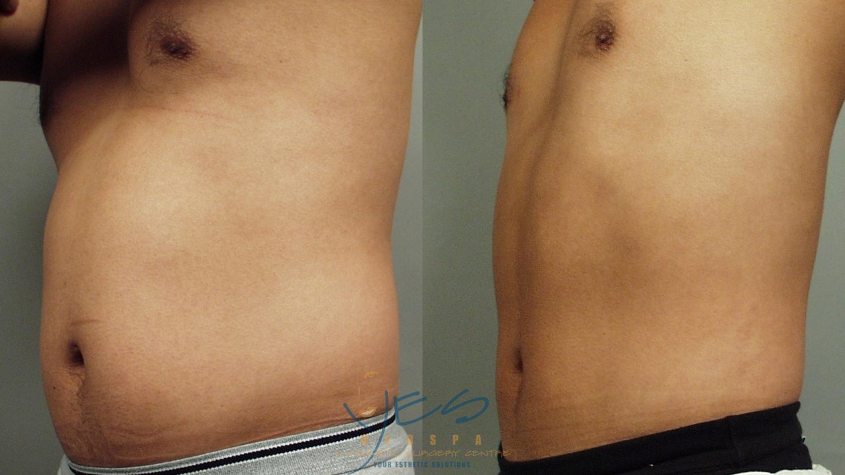 Before & After Liposuction Case 49 Left Oblique View in Vancouver, BC