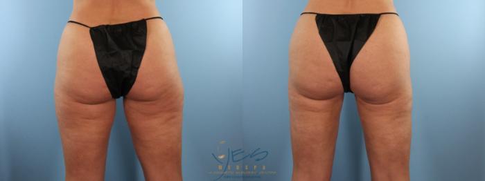 Before & After Liposuction Case 520 Back View in Vancouver, BC