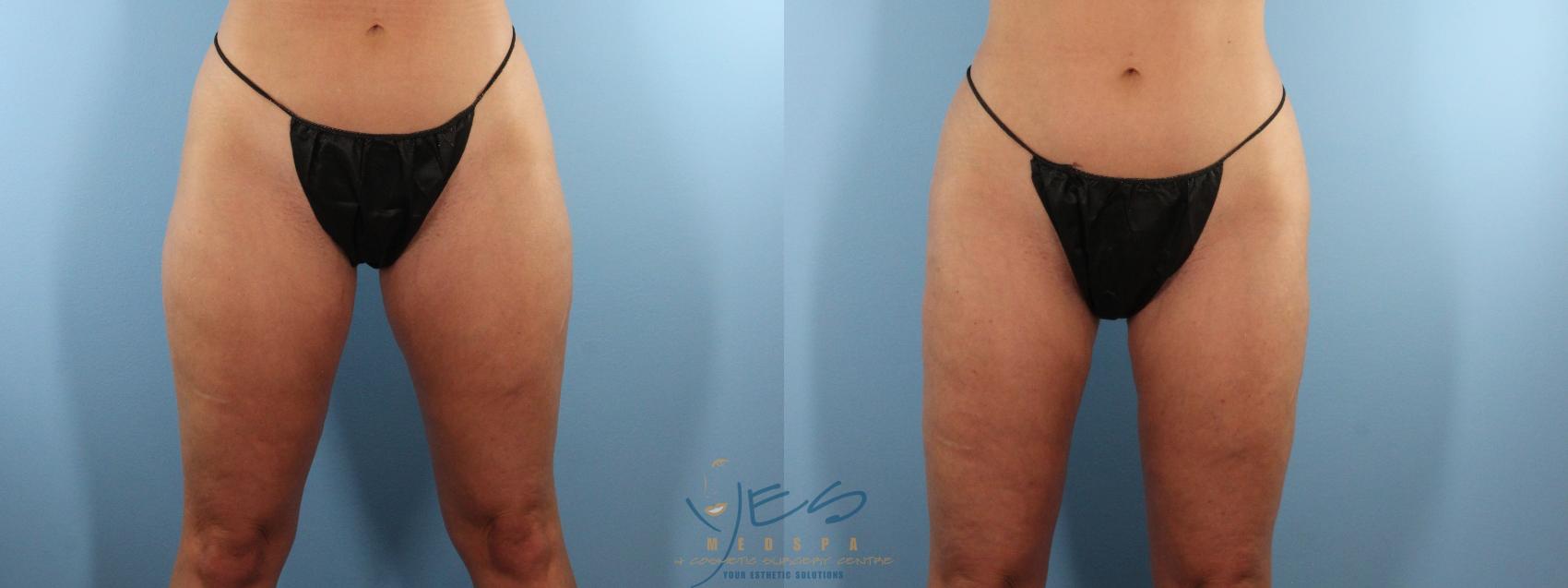 Before & After Liposuction Case 520 Front View in Vancouver, BC