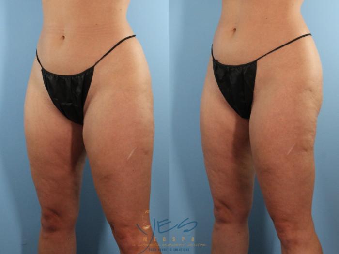 Before & After Liposuction Case 520 Left Oblique View in Vancouver, BC