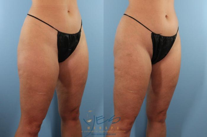 Before & After Liposuction Case 520 Right Oblique View in Vancouver, BC