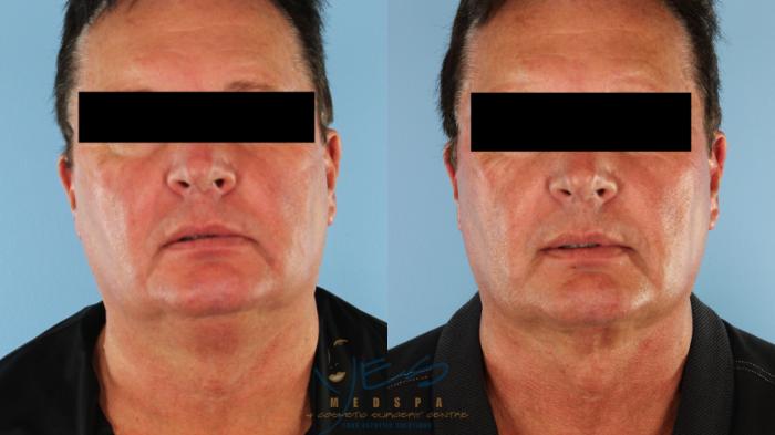 Before & After Liposuction Case 586 Front View in Vancouver, BC