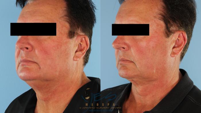 Before & After Liposuction Case 586 Left Oblique View in Vancouver, BC