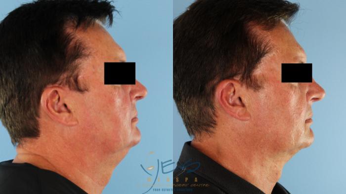 Before & After Liposuction Case 586 Right Side View in Vancouver, BC