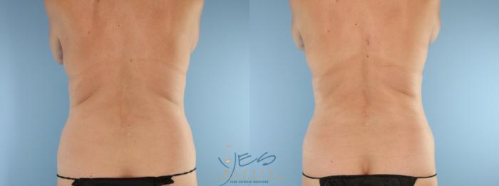 Before & After Liposuction Case 595 Back View in Vancouver, BC