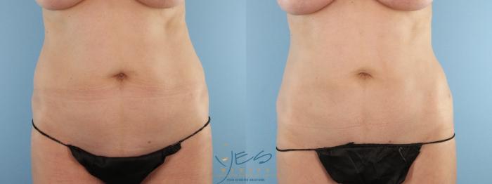 Before & After Liposuction Case 595 Front View in Vancouver, BC