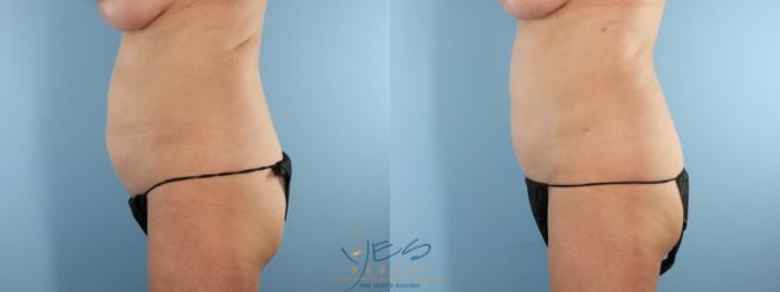 Before & After Liposuction Case 595 Right Oblique View in Vancouver, BC