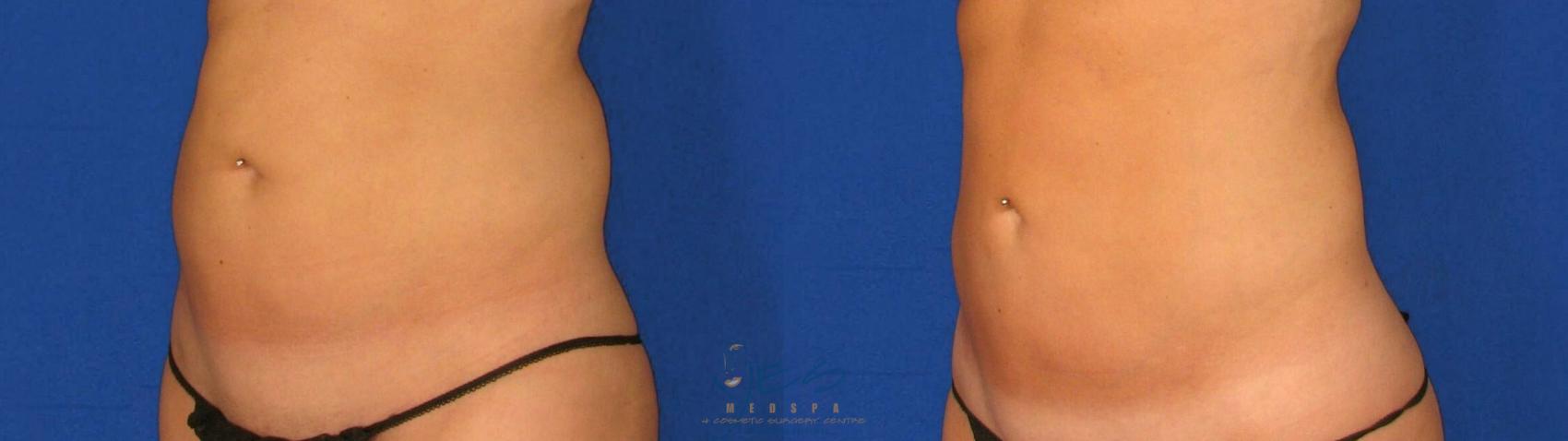 Before & After Liposuction Case 71 Left Oblique View in Vancouver, BC