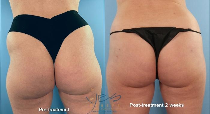 Before & After Liquid Body Contouring Case 471 Back View in Vancouver, BC