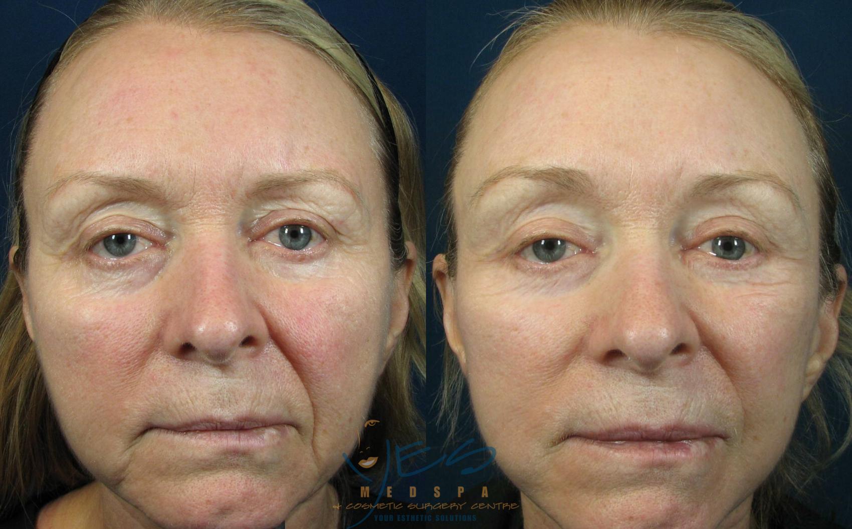 Before & After Lower Eyelid Blepharoplasty Case 119 View #1 View in Vancouver, BC