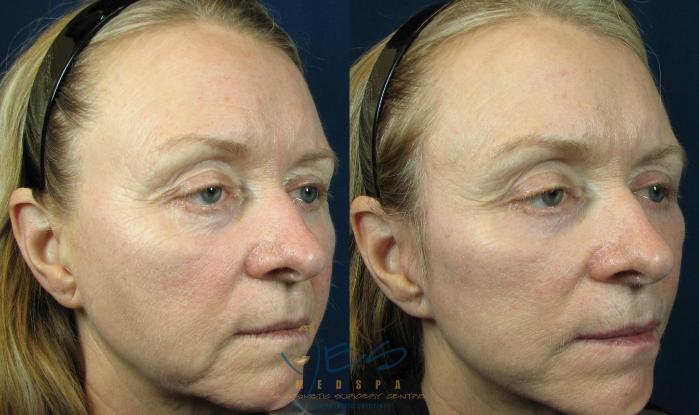 Before & After Lower Eyelid Blepharoplasty Case 119 View #2 View in Vancouver, BC