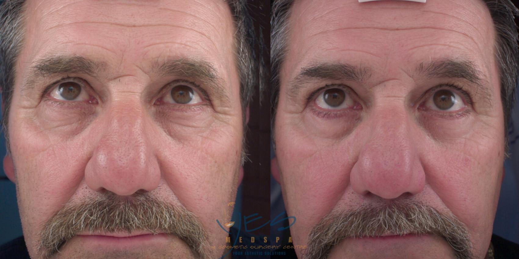 Before & After Lower Eyelid Blepharoplasty Case 142 Front View in Vancouver, BC