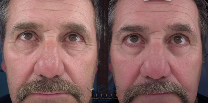 Before & After Lower Eyelid Blepharoplasty Case 142 Front View in Vancouver, BC