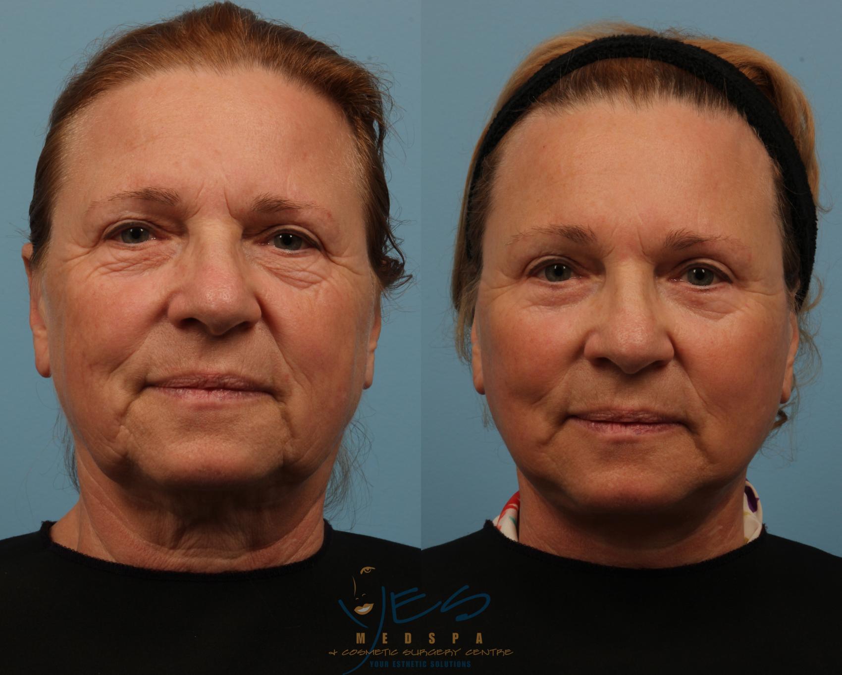 Lower Eyelid Blepharoplasty Before After Photos Patient 150   Lower Eyelid Blepharoplasty 150 View 1 Detail 