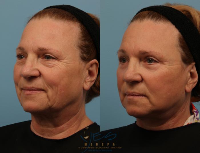 Before & After Lower Eyelid Blepharoplasty Case 150 View #2 View in Vancouver, BC