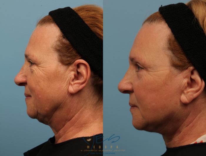 Before & After Lower Eyelid Blepharoplasty Case 150 View #3 View in Vancouver, BC