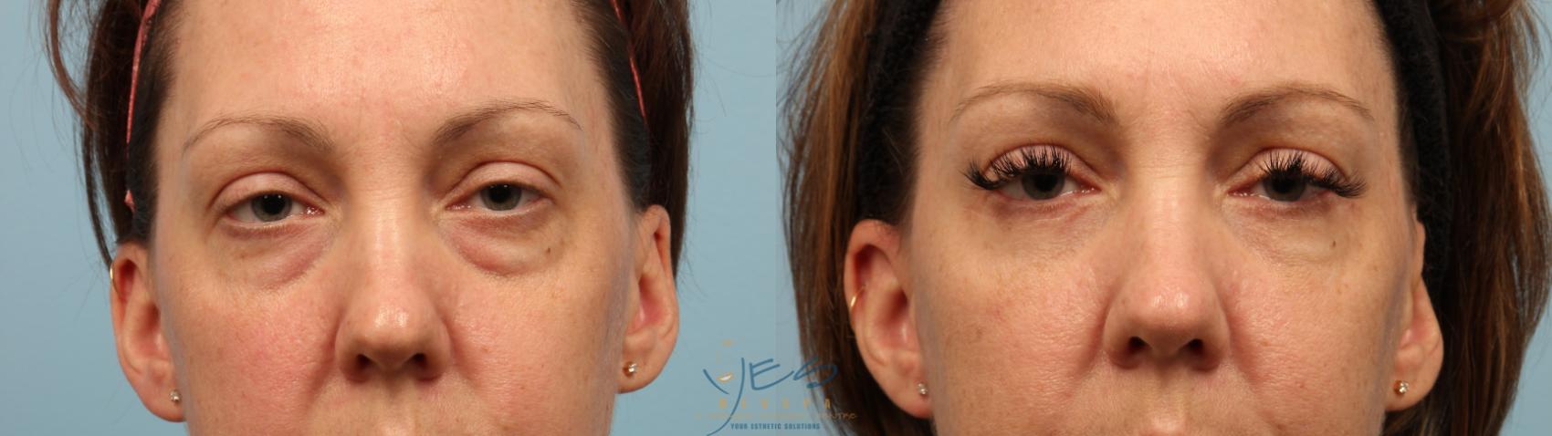 Before & After Upper & Lower Blepharoplasty Case 288 Front View in Vancouver, BC