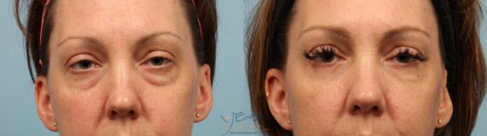 Before & After Lower Eyelid Blepharoplasty Case 288 Front View in Vancouver, BC