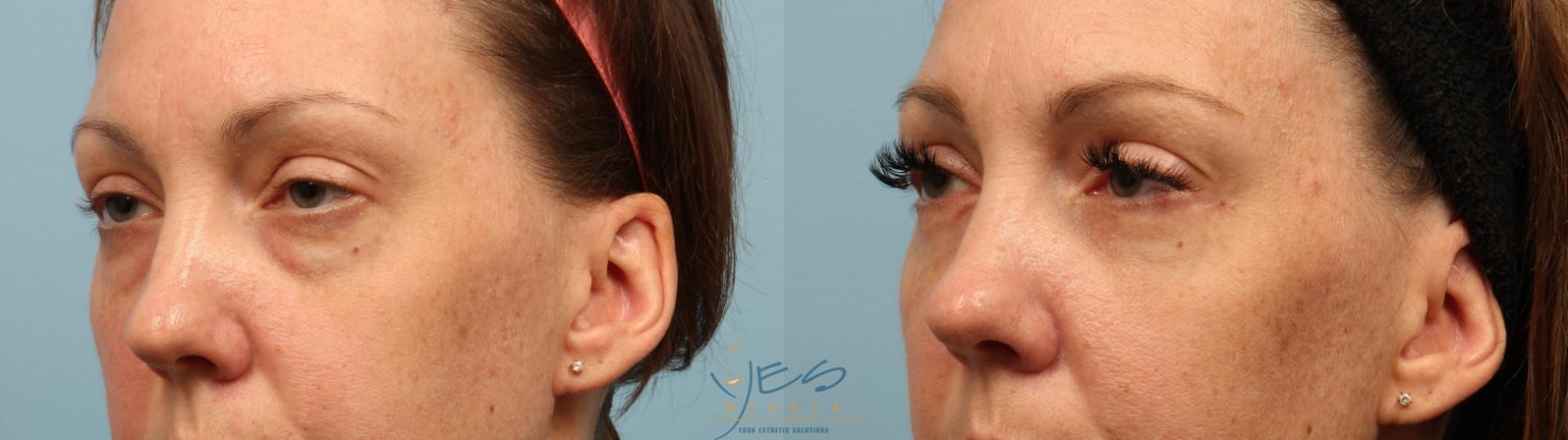Before & After Upper & Lower Blepharoplasty Case 288 Left Oblique View in Vancouver, BC